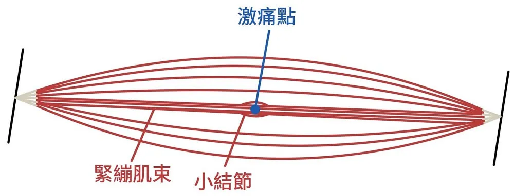梭形肌肉線圖,中間標出藍點代表激痛點,下方文字分別指向緊繃肌束與那顆小結節