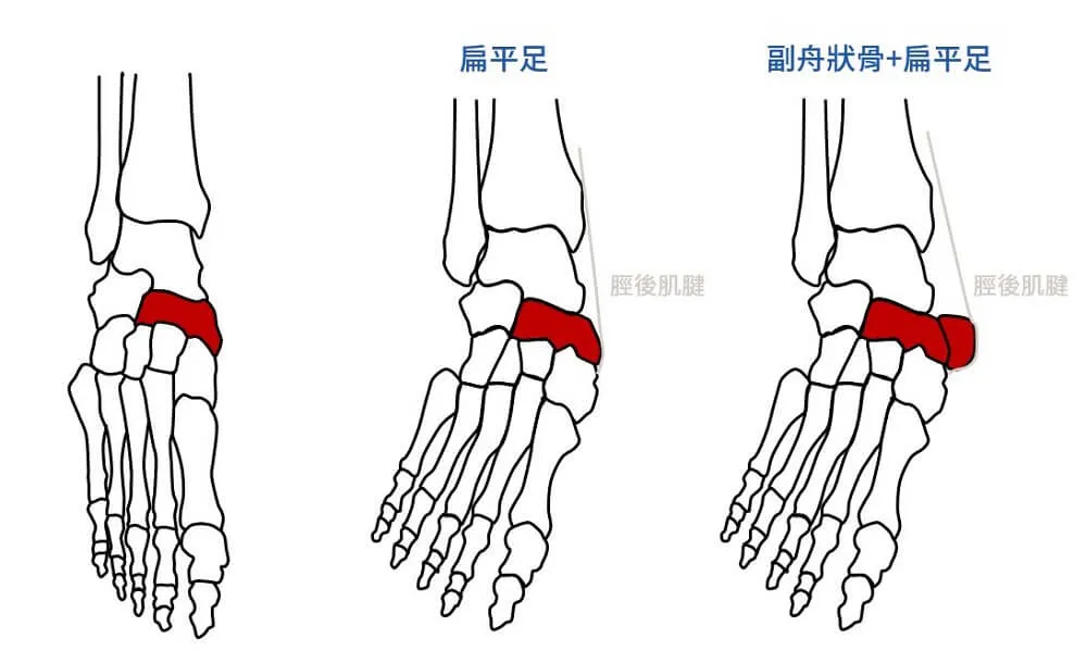 副舟狀骨加上扁平足,會使肌腱及骨頭受更大的壓力