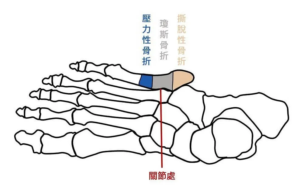 以第四及第五蹠骨關節處做為分界,定位傷處