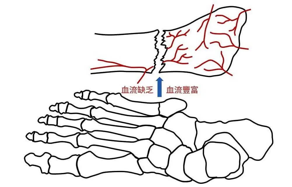 壓力性骨折及瓊斯骨折處都屬血流供應缺乏的區域,不利於復原