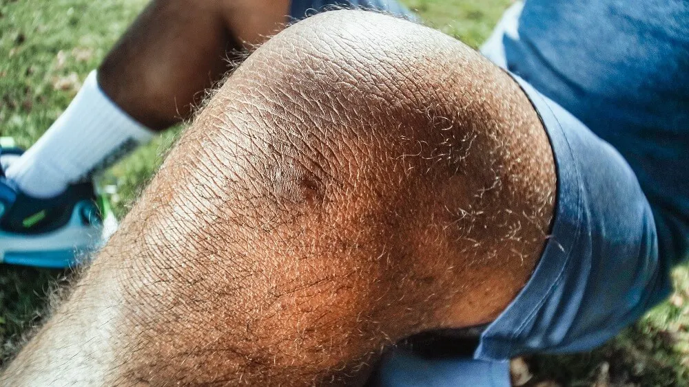 任何膝蓋急性受傷都會伴隨腫脹,需要盡快處理