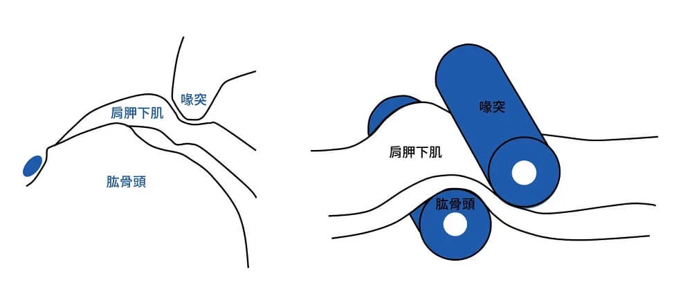 Roller-wringer effect 對照線稿,左圖標出喙突、肱骨頭與夾在中間的肩胛下肌,右圖把兩塊骨頭畫成藍色滾筒絞壓肌腱