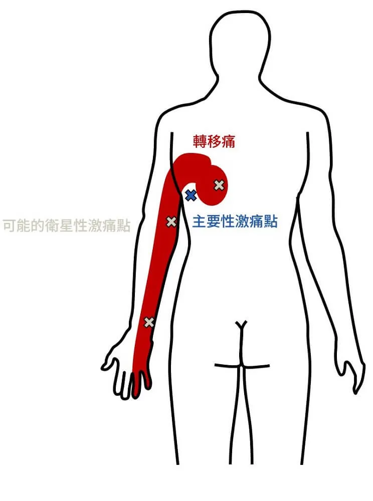 以闊背肌為主要激痛點,其轉移痛區域可能造成三處衛星激痛點