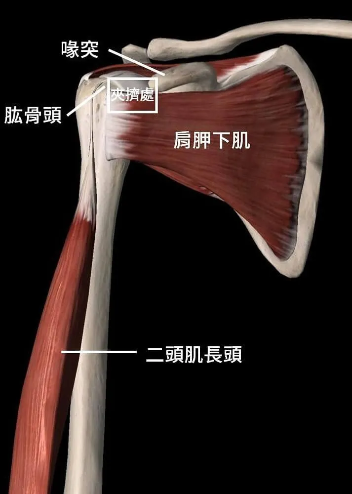 肩關節前側 3D 解剖圖,標示喙突、肱骨頭、肩胛下肌與二頭肌長頭,白框圈出喙突與肱骨頭之間的夾擠處