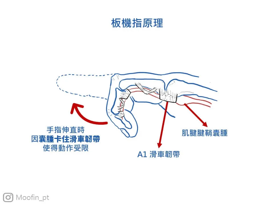 腱鞘若是因為受傷腫大,在手指活動時就會容易有卡頓感